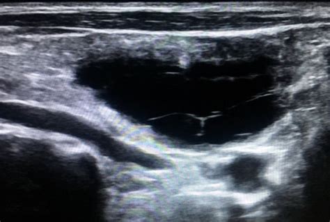 Supraclavicular Lymphangioma Radiology Celestial Ultrasound