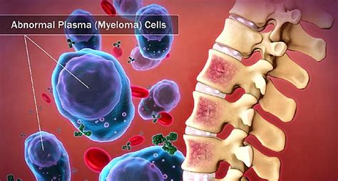 Treatment Of Multiple Myeloma Uptodate Canceroz