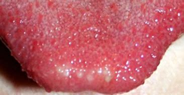 Explore the tip of the tongue language learning. How To Get Rid Of White Tongue Permanently? - Ayur Health Tips