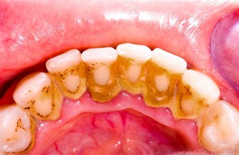 how to remove coffee stains from teeth at home teethwalls