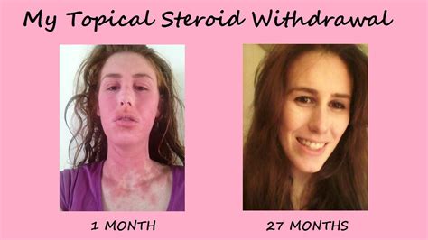 My Topical Steroid Withdrawal Youtube