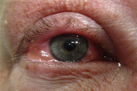 Allergic Eye Disease Itching To Know More Eyeonoptics