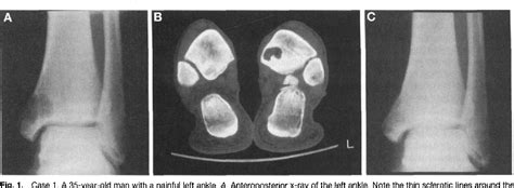 Figure From Intraosseous Ganglion Cysts Of The Ankle A Report Of Three Cases With Long Term