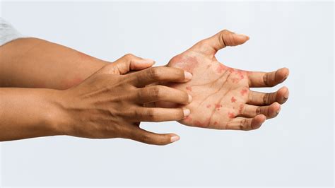 Coronavirus Symptoms May Include Skin Rashes Scientists Say Thegrio
