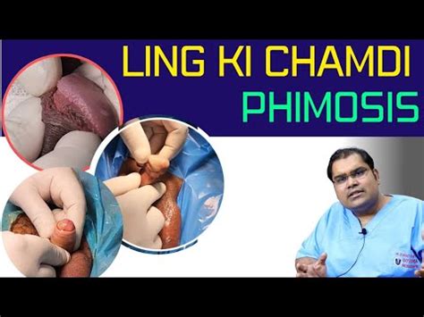 Phimosis Examples What Is Phimosis Youtube