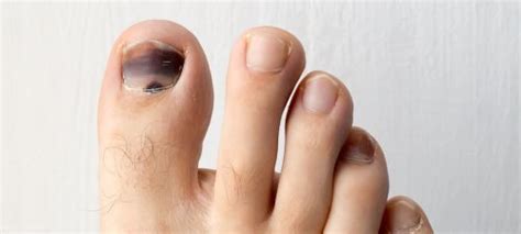 How To Prevent Black Toenail From Running Easy Tips To Follow