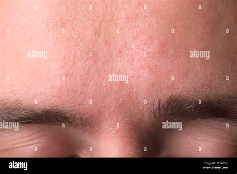 Weeping Eczema In The Stage Of Exudation Closeup Of Forehead Area With
