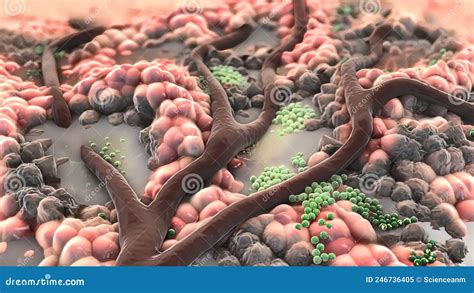 Animatied Of Infected Wound Bacteria Pus Abscess Stock Illustration