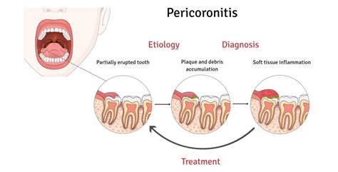 Pericoronitis Management All You Need To Know Dr Rajat Sachdeva