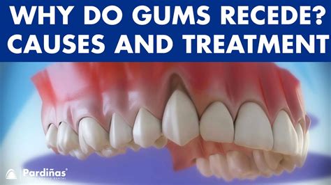 Gum Recession Treatment Of Gingival Retraction Youtube