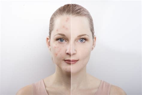 Women With Acne Scars