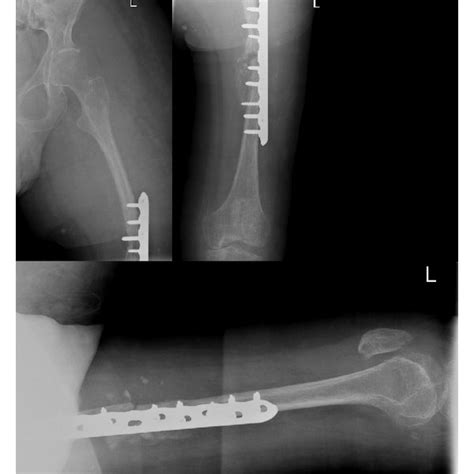 Ap And Lateral Radiographs Of The Left Femur Demonstrating A Complete