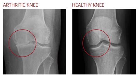 Knee Arthritis Total And Uni Knee Replacement And Osteotomy
