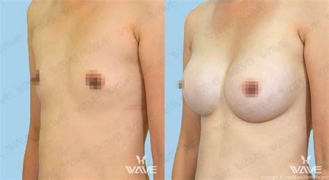 Breast Augmentation In Los Angeles Wave Plastic Surgery