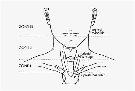 Download Definition Of The Three Anatomic Zones Used In Neck
