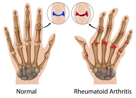 What Is Arthritis It Could Be Gout Rheumatoid Arthritis Or