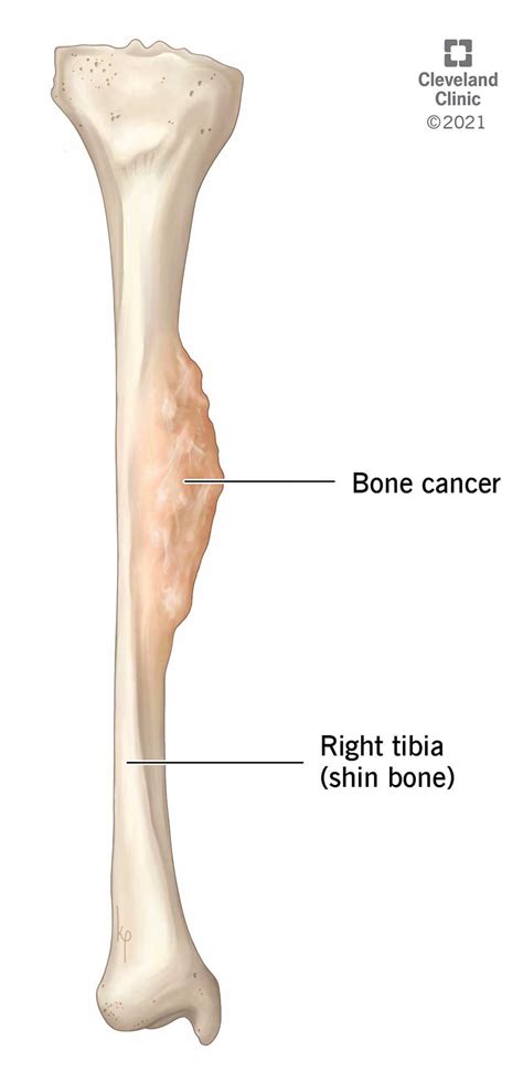 Câncer ósseo Sintomas Sinais Tratamento Causas E Estágios