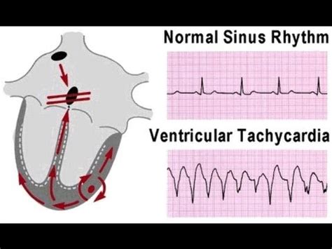 Ventricular Tachycardia V Tach Vt Causes Symptoms Management Youtube