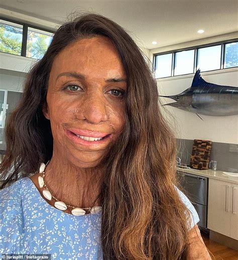 Inspirational Burns Survivor Turia Pitt On Life Lessons From Pandemic Sound Health And Lasting