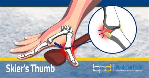 Skiers Thumb Hand Specialist Brandon P Donnelly Md