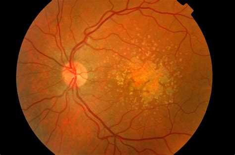 researchers  hiv drug     fight dry amd optician