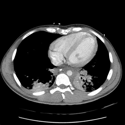 Traumatic Aortic Injury Radiology Case