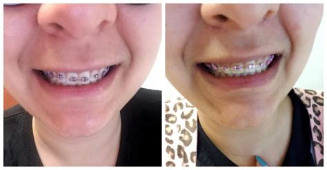finally getting my bottom braces almost 11 months later left photo from 6 18 right from