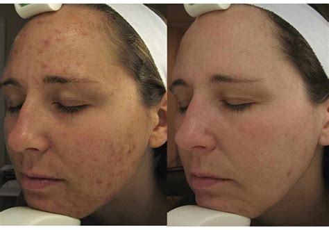 Before And After Laser Treatment For Acne Scars Before And After
