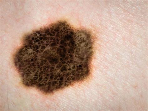 Your Guide To Metastatic Melanoma Clevertopic