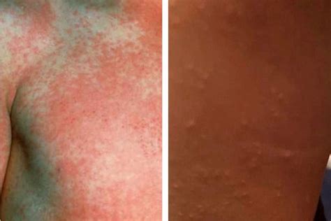 How To Spot The Symptoms Of Scarlet Fever In Your Child Madeformums