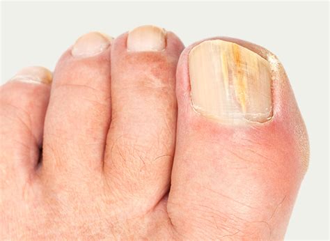 Skin And Nail Care Dermatology — 2 Right Feet Podiatry Yarra Valley