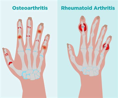 Rheumatoid Arthritis Vs Osteoarthritis Prof Dr Robert Hierner