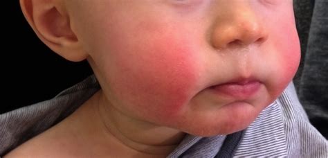 What Are The Signs And Symptoms Of Fifth Disease Storymd
