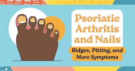 Psoriatic Arthritis And Nails Ridges Pitting And More Symptoms