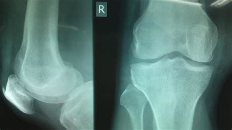 Plain X Ray Of The Right Knee Showing A Soft Tissue Swelling On The