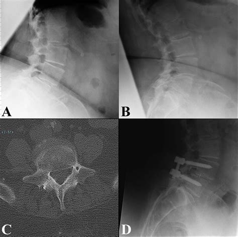 Cureus Unilateral Pedicle Screw Fixation Is Associated With Reduced
