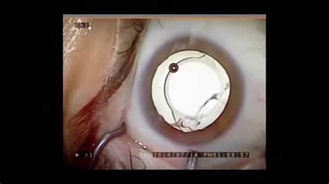 Dropless Cataract Surgery Series Youtube