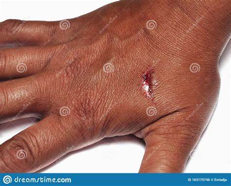 Scratch And Blood On Human Hand On White Injury And Healthcare Stock