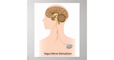 Vagus Nerve Stimulation Therapy Poster Zazzle