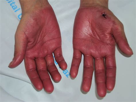 Acral Erythema Worsened By Intravenous Infusions Of Cyclosporine
