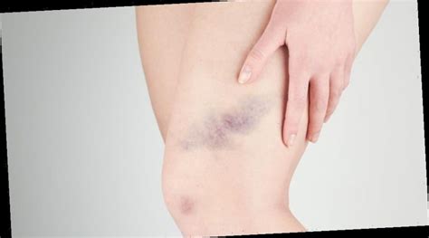 What Do The Colors Of Bruising Mean The Meaning Of Color