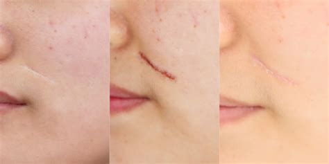 Co2 Laser Before And After Acne Scars