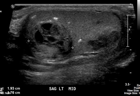 Embryonal Cell Carcinoma Ultrasound