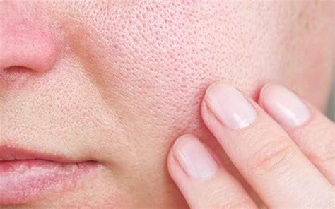 Difference Between Large Pores And Acne Scars Reequil