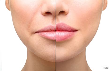 4 Things You Need To Know About Lip Fillers Temecula Ca Dr Kelly