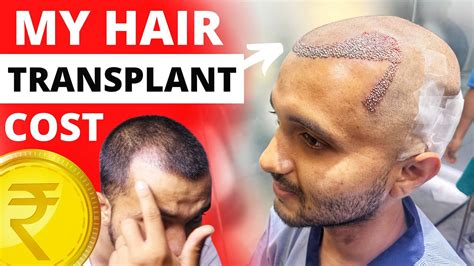 Update Hair Transplant Day Actual Cost Of My Hair Transplant