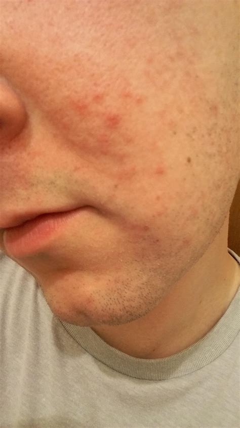 Skin Concerns Pimples Spreading On Cheeks Skincareaddiction