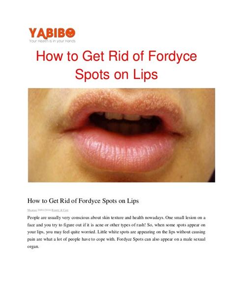 How To Get Rid Of Fordyce Spots On Lips