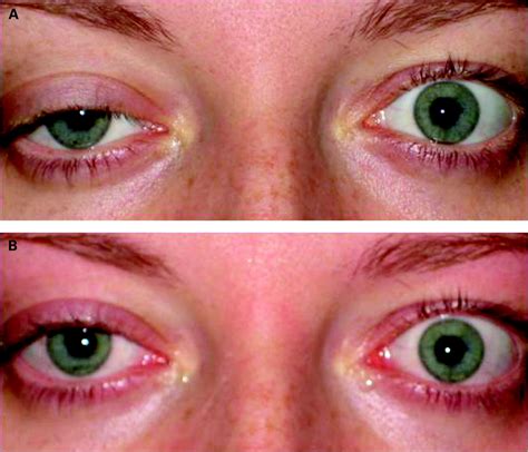 Published online 15 july 2014; Positive "ice-on-eyes" test in Miller Fisher syndrome ...