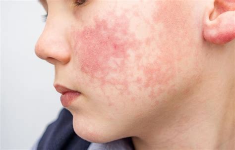 Alergia na pele quais são os tipos sintomas e como tratar Saúde